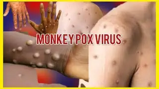 Breaking News: Monkey Pox Virus is spreading globally at high speed