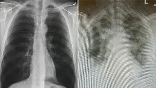 ER doctor shares alarming lung X-rays of COVID-19 patients