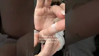 Removing A Wart | A collection of the Wart Removal process | in depth details on my page and TikTok