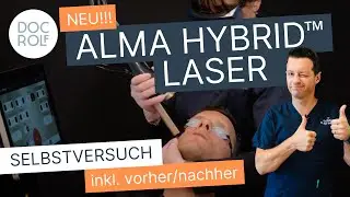 ALMA (CO2) HYBRID™ LASER Selbstversuch und vorher/nachher an Dr. Rolf Bartsch