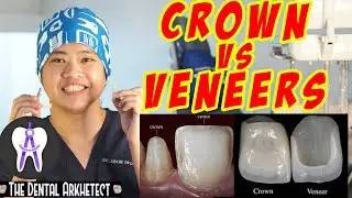 Kaibahan ng Dental Veneer at Crown (Jacket) #veneer #dentalcrown
