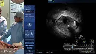 PCI Of LAD Under IVUS Guidance