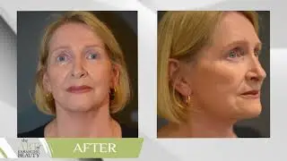 FACE LIFT