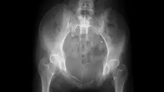 How to Read an Inlet Pelvis Xray