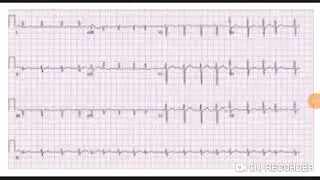 Neet pg 2020 exam Ecg image based mcq