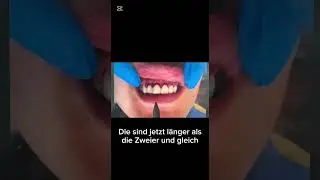 Gummy Smile Korrektur & Smilemakeover