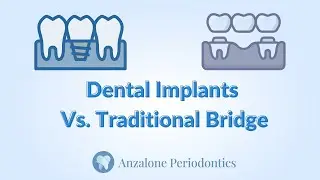 Anzalone Periodontics - Dental Implants Vs Traditional Bridge