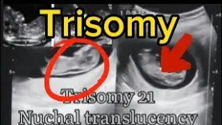 Nuchal translucency, Down syndrome , trisomy 21 #ultrasound #pregnancy #baby