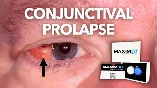 How to Fix Conjunctival Prolapse in Scleral Lens Patients