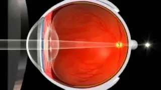 Spec Correction for Hyperopia