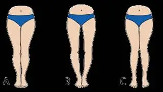 Bow legs no more review &ndash; Does Bow legs no more really work
