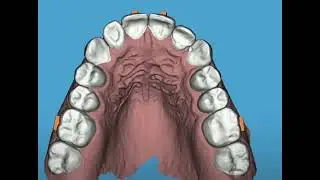 Alignment worn teeth