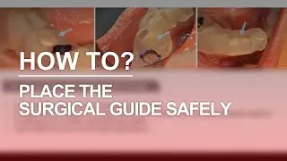 Safely place the surgical guide (DIOnavi.)