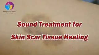 Skin Scar Removal丨Tissue Regeneration丨Healing Frequency丨Get Smooth Skin