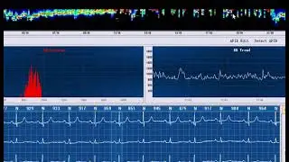 check how to use Meditech Holter ECG Heartrec ECO Pro and Lite model Part2