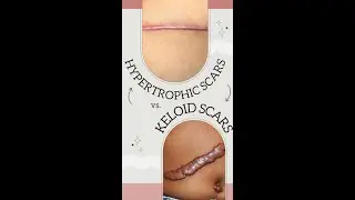 Hypertrophic Scars vs Keloid Scars: How to Tell the Difference & What to Do About Them