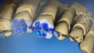 Konstruktion einer Teilkrone mit CEREC (morphen)