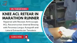 Knee ACL retear in marathon Runner 👨&zwj;⚕️
