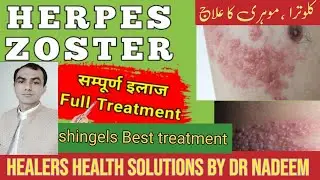 Herpes zoster/Shingels best treatment