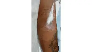 Gruesome Heroin Drug User Arm Infection from Dirty Needles.