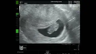 ♡다이아 8주차 5일(태아 초음파)