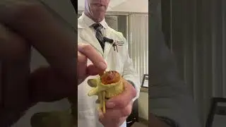What is Degenerative Disc Disease (DDD)?
