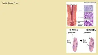 Penile cancer Explained Causes, Symptoms and Treatment, All Insights