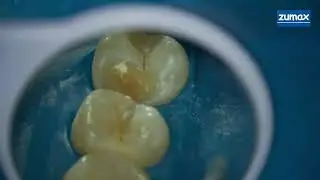 DIRECT PULP CAPPING