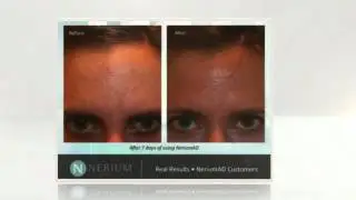 Non Surgical Facelift | NeriumAD | Before and After Views