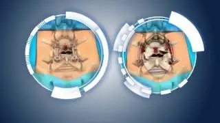 Legacy MIGLIF Patient Education Animation