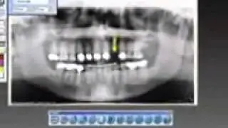 Owandy Krystal-X Digital Sensor