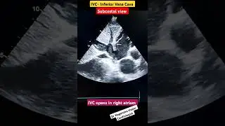 IVC Echo I subcostal view l #echo #shorts