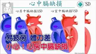 台中榮總-心中膈缺損致先天性心臟病，微創心導管手術效果佳！