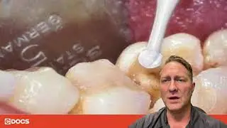 Tip of the Day: Ceramic Round Bur
