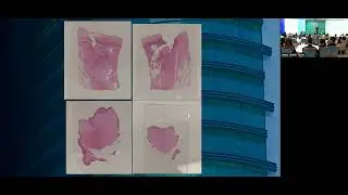 Histopathology of Pilonidal Sinus - Rawa Muhsin (25/09/2023)