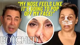 Will Renee's Nose Will FALL OFF After 3 Botched Rhinoplasties?! *FULL TRANSFORMATION* | Botched | E!
