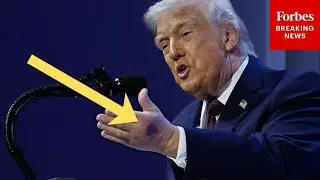 BREAKING NEWS: Trump Addresses Bruising On Hand During Davos After Reporter Question