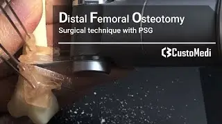 Distal Femoral Osteotomy(DFO) - Surgical technique with patient-specific surgical guides