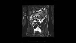Crohn's Disease - Active Inflammation Overview