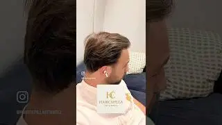 #sa&ccedil;ekimi #hairtransplant #fue #dhitechnique #beforeafter #haircapilla #istanbul #shorts