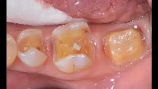 CEREC: Herstellung von Inlays im Chairsideverfahren