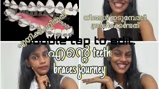 പല്ലിൽ കമ്പി ഇട്ടിട്ട് എനിക്ക് ഉണ്ടായത് 😭വീണ്ടും restart ചെയ്ത#dentalbraces #ytvideo #bracesjourney