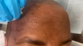 UltraClear Laser for Dark Skin: Safe Hyperpigmentation Treatment | Dr. Shashi Kusuma In Weston, FL