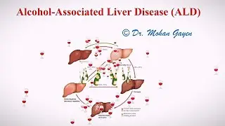 Alcohol-Associated Liver Disease(ALD) | Alcoholic Hepatitis | © Dr. Mohan Gayen