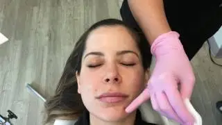 Demonstration of Chemical Peel
