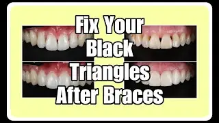 Fix your black triangles after braces!