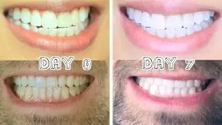 Best Teeth Whitening for Stains & Dental Work