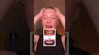 Я НОШУ БРЕКЕТЫ 3 месяца👀😩🙏🏻 УЗ #брекеты #уходзазубами