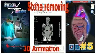nephradenoma removing surgery || surgery master || Level 5