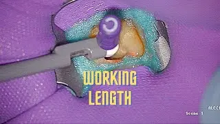 Simple Root Canal Working Length Tip